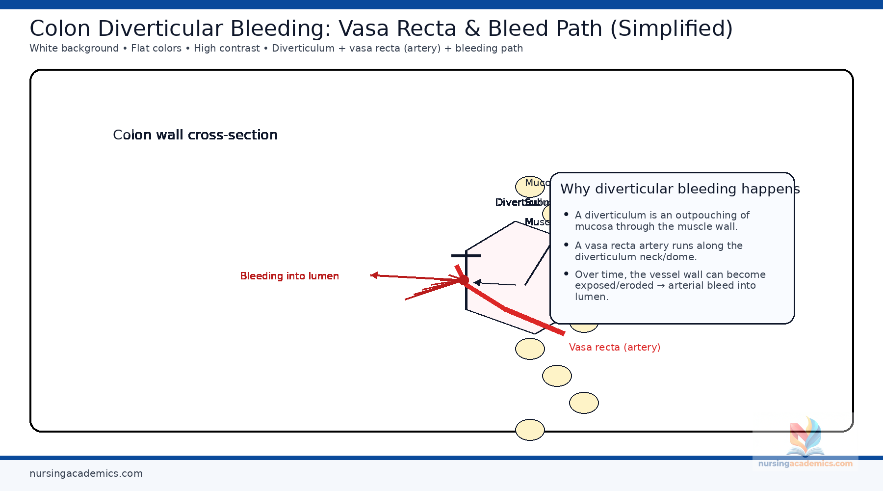 Colon diverticulum and vessel visual
