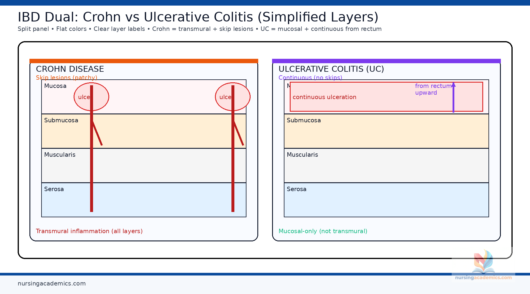 Crohn vs Ulcerative Colitis diagram
