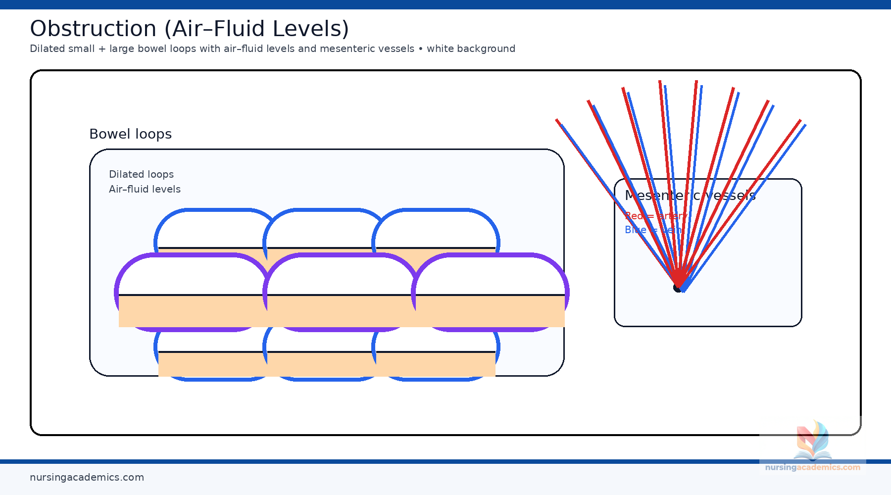 Bowel obstruction illustration